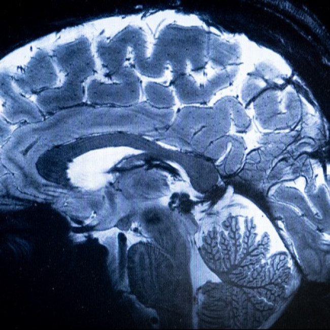 Simple brain test can detect Alzheimer's years in advance