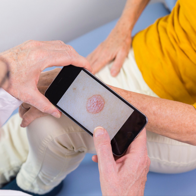 AI app detects skin cancer warning signs through smartphone camera